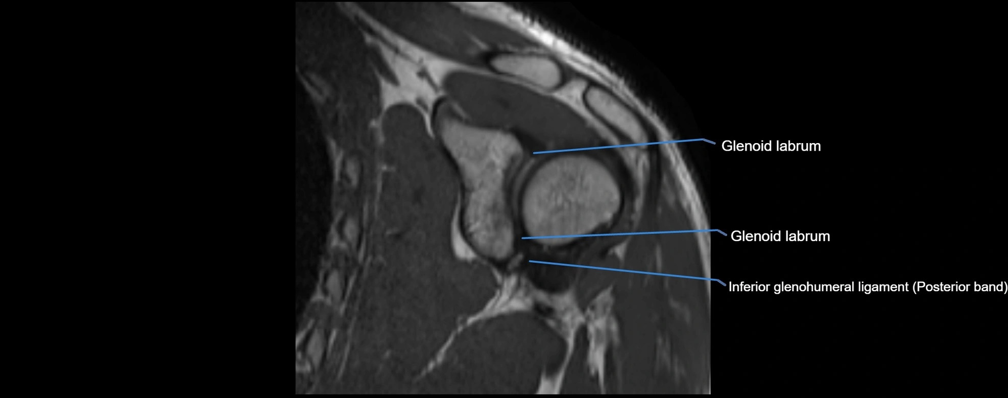 shoulder ligments coronal  cross sectional anatomy 3T MRI AI enhanced radiology image -img-00001-00030.webp